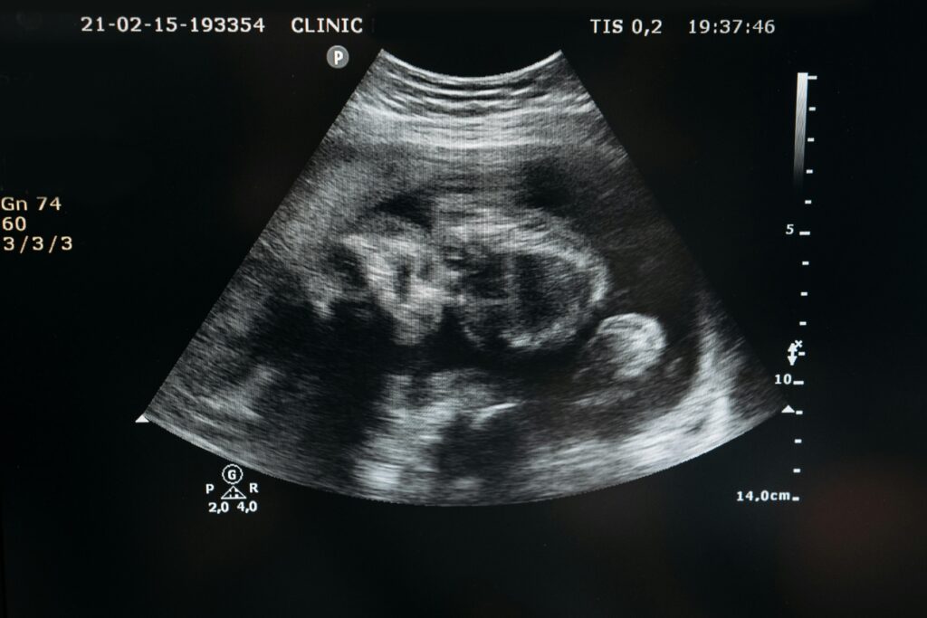 Ultrasound image